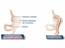 Chirurgie bariatrique : définition et techniques d'intervention