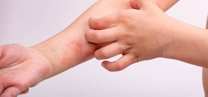 Urticaire chronique et allergie : reconnaitre les différences
