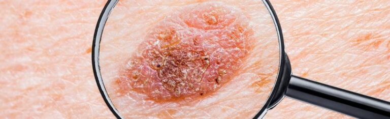 Carcinome basocellulaire : Définition, symptômes et diagnostic