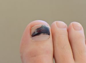 hématome ongle
