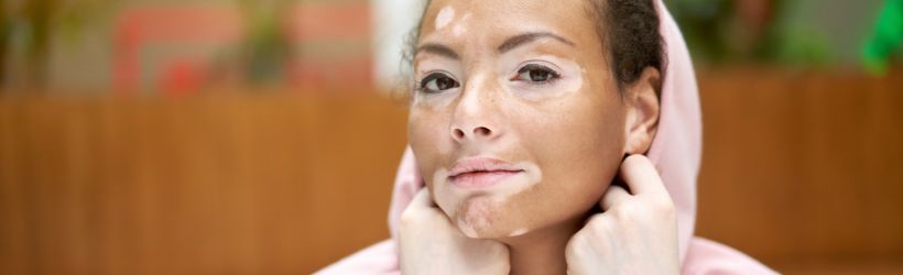 Vitiligo : Définition, symptômes et diagnostic - Santé sur le Net