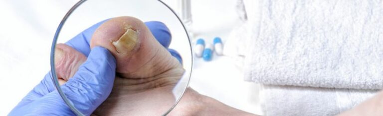 Mycose cutanée : causes, symptômes et traitement