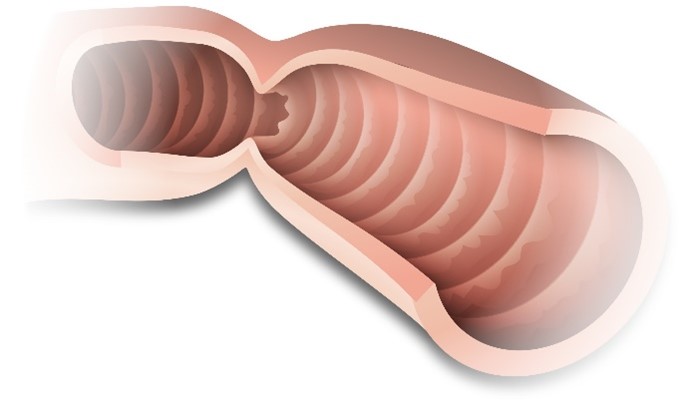 Occlusion intestinale : Définition et symptômes - Santé sur le Net