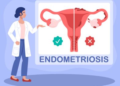 Endométriose : symptômes, diagnotic, traitements