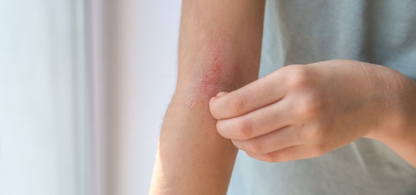 header psoriasis de l'enfant : symptômes et traitements