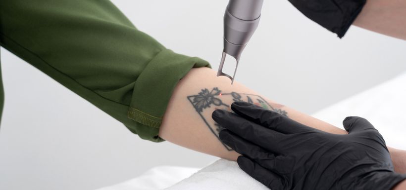 Détatouage