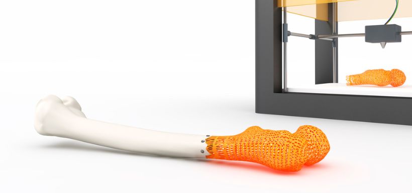 prothèse 3D orthopédie
