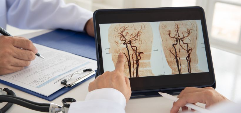 header article AVC nouvelle méthode de traitement