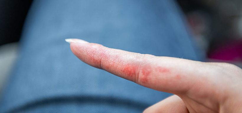 header article dyshidrose