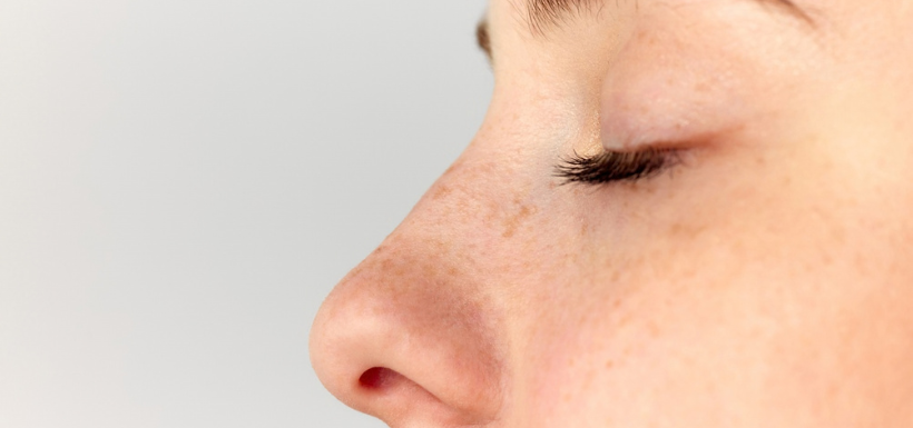 Le roaccutane fait-il mincir le nez ?