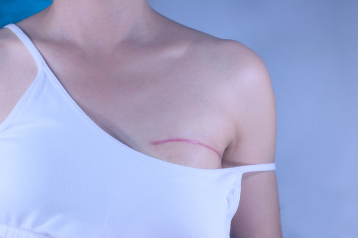 Breast cancer surgery scars