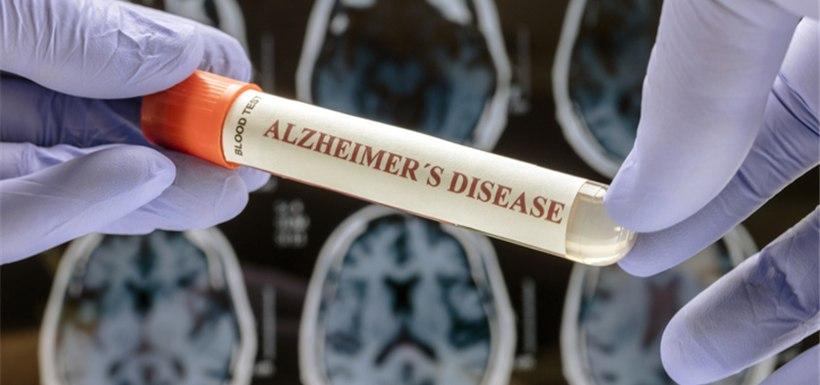 alzheimer-prise-de-sang-diagnostic-premiers-symptomes Un tube de prise de sang étiqueté maladie d’Alzheimer devant des IRM du cerveau